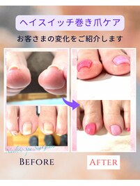 巻き爪ケア+フットマッサージ付