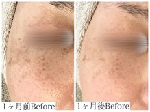 フルール(FLEUR)/シミ改善