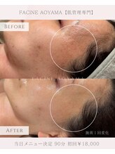 ファシネアオヤマ(FACINE AOYAMA)/理想のお肌へ♪