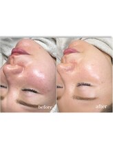 サロン ド ベル(salon de Belle)/艶肌ワックス後最高峰炭酸パック