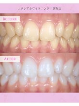 エクシアホワイトニング 調布店/20代女性会員様/ブライダルケア
