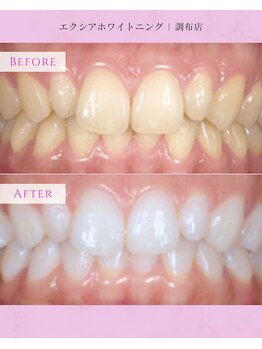 エクシアホワイトニング 調布店/20代女性会員様/ブライダルケア