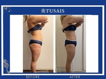 ビテュセ(美Tu sais)/【ダイエット・痩身】ボディケア