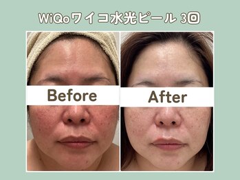 プティ カシェット 伊丹店(petit cachette)/ワイコwiqoビフォー・アフター1