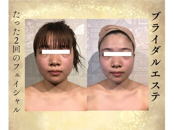 サンテボーテ(Sante Beaute)/ブライダルエステ