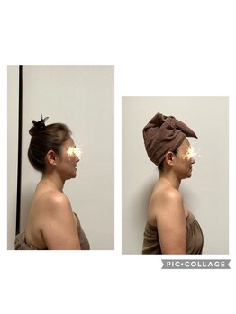 ケニー(Kenny)/ラジオ波フェイシャル