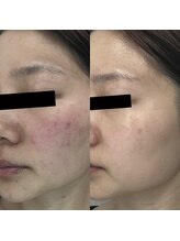 クロム(CHROME)/水光ピーリング　