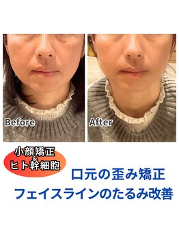 プルベル 宇都宮店(Plus Belle)/小顔矯正/たるみ改善/しわ改善