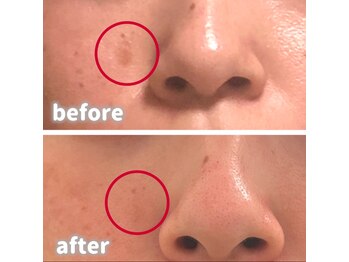 ホワイト ターコイズ/シミケア/10回