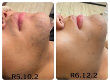 フィズ 五日市彩が丘店(FIS)/☆before/after☆五日市脱毛