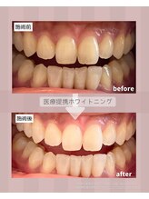 ハチ(HACHI)/医療提携ホワイトニング