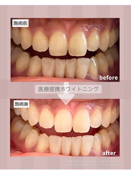 ハチ(HACHI)/医療提携ホワイトニング