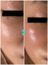 ミルキー(Milky)/マツヤニxクレイでツルピカ肌