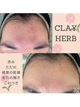 スリジエ ボーテ(cerisierBEAUTE)/なかなか改善されないニキビケア