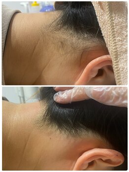 アロラヴィ(AroRavi)/襟足脱毛