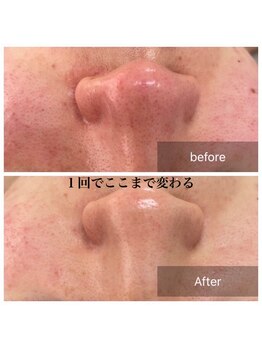 アルゴ 八幡黒崎店(ALGO)/毛穴の開き、赤み気になる方