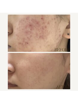 レヴ 都城店(rev)/REVIハーブピーリング