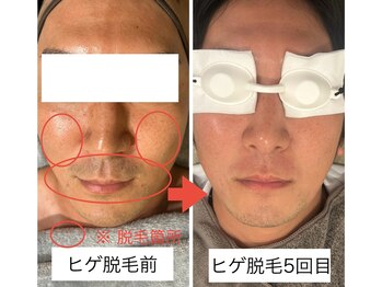 アリ(ALI)/ヒゲ脱毛5回目