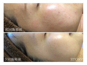 ストーリー 沼津店(STORY)/ハーブピーリング専門店STORY