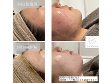 ラヴィオーラ 福島野田店(La Viora)/ダイヤモンドハーブピーリング