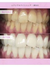 エクシアホワイトニング 調布店/40代男性会員様/清潔感UP！