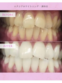 エクシアホワイトニング 調布店/40代男性会員様/清潔感UP!