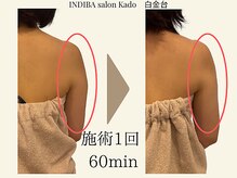 スラリ二の腕♪落としづらい脂肪こそインディバ痩身がオススメ！