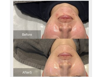 アリアサンティエ(Alia Scintiller)/プラズマ→純粋レチノールピール