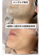 マウム(Maum)/青ヒゲ・朝の髭剃りの時間解消へ