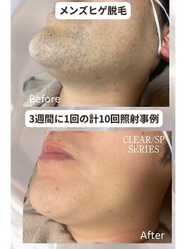 マウム(Maum)/青ヒゲ・朝の髭剃りの時間解消へ