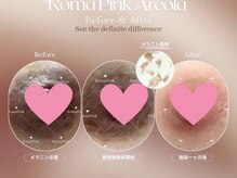 アンジェロ(Angelo)/ローマピンク施術【バスト】