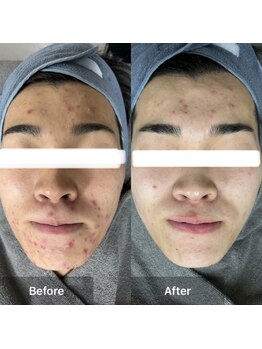 モカ 天王寺店(MOKA)/剥離 ハーブピーリング 予防