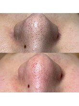 トット 恵比寿(totto)/毛穴ケアビフォーアフター