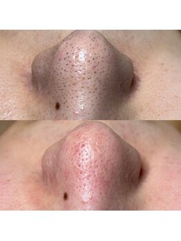 トット 恵比寿(totto)/毛穴ケアビフォーアフター