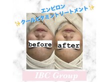トータルサロンアイビーシー(トータルサロンIBC)/エンビロンで美白、美肌に