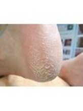 巻き爪補正店 西宮北口店/角質ケア