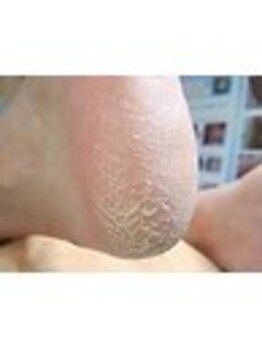 巻き爪補正店 西宮北口店/角質ケア