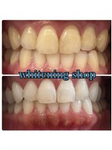 ホワイトニングショップ 米子店/ホワイトニングビフォーアフター