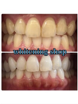 ホワイトニングショップ 米子店/ホワイトニングビフォーアフター