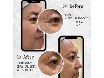 アプリコット(Apricot)