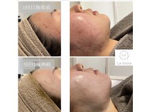 ラヴィオーラ 福島野田店(La Viora)/ダイヤモンドハーブピーリング