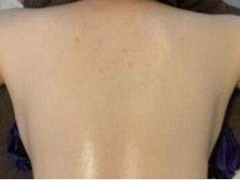 キレミカ 下関店の写真/肌見せの時期に是非おすすめのメニュー◎【目指せ背中美人】長年悩まれている背中ニキビケアに！8,800円★