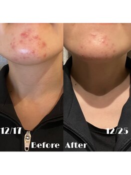 #美容革命ラボ 大阪南堀江店/艶肌ハーブピーリング/梅田難波