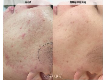 ハーバル 新宿店(HERBAL)/最強★韓国FCRハーブピーリング