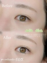 ドース(DOSE)/ハイブリッドロッド