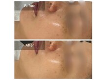 シューラディアント 金沢店(ShuRadiant)の雰囲気（小鼻の黒ずみ、毛穴、シミ改善にはハイドロ毛穴洗浄&ピーリング）