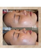 ウリ(uli beauty)/比較写真