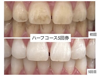 ホワイトニングショップ 明石大久保店/【BeforeAfter】5回券のお客様