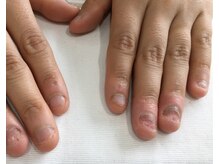 ネイルアンドアイラッシュ アヴィ(Nail and Eyelash A'vi)/自爪育成前