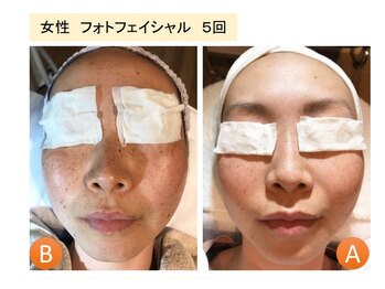 ラグゼ(LUXE)/光フェイシャル初回半額!!